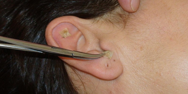 Auriculoterapia
